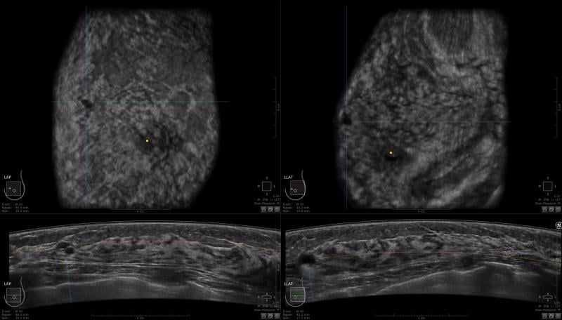 GE Invenia ABUS Aids Cancer Detection in Dense Breasts | Imaging